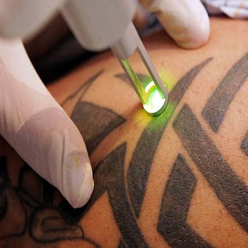 Удаление татуировок и гиперпигментаций